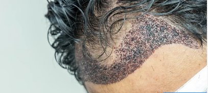 Área receptora do couro cabeludo nos primeiros dias após transplante capilar por FUE, com crostas e folículos recém-implantados